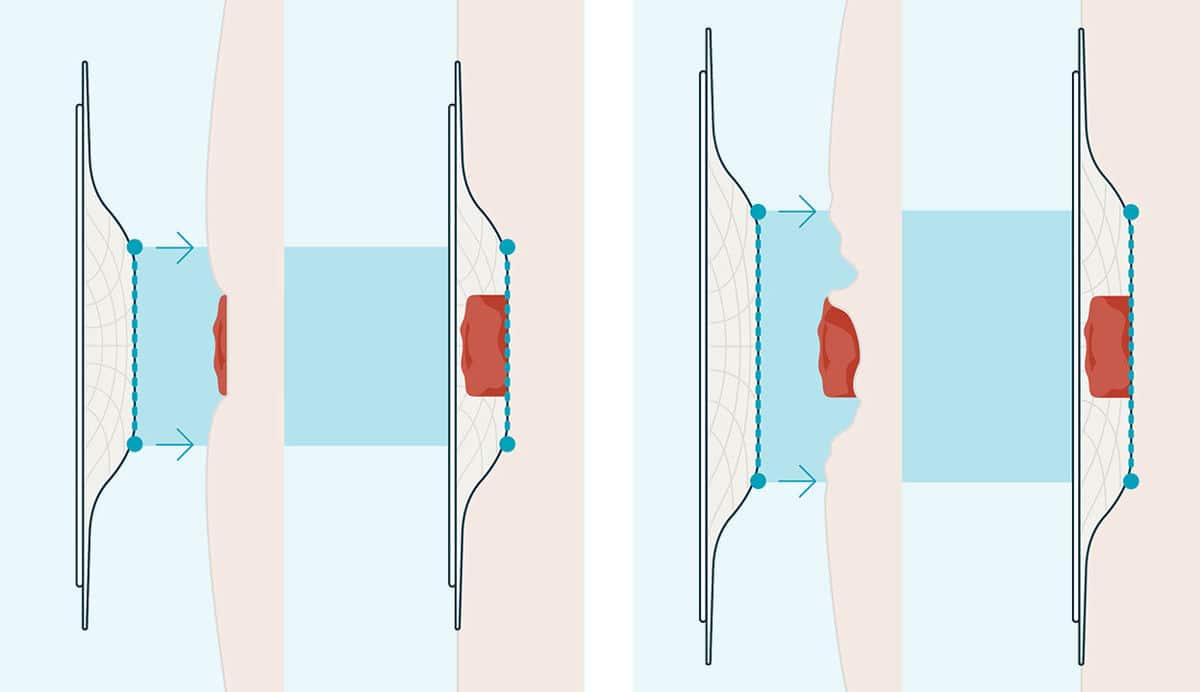 Tension Location positioning is key<sup>3</sup>